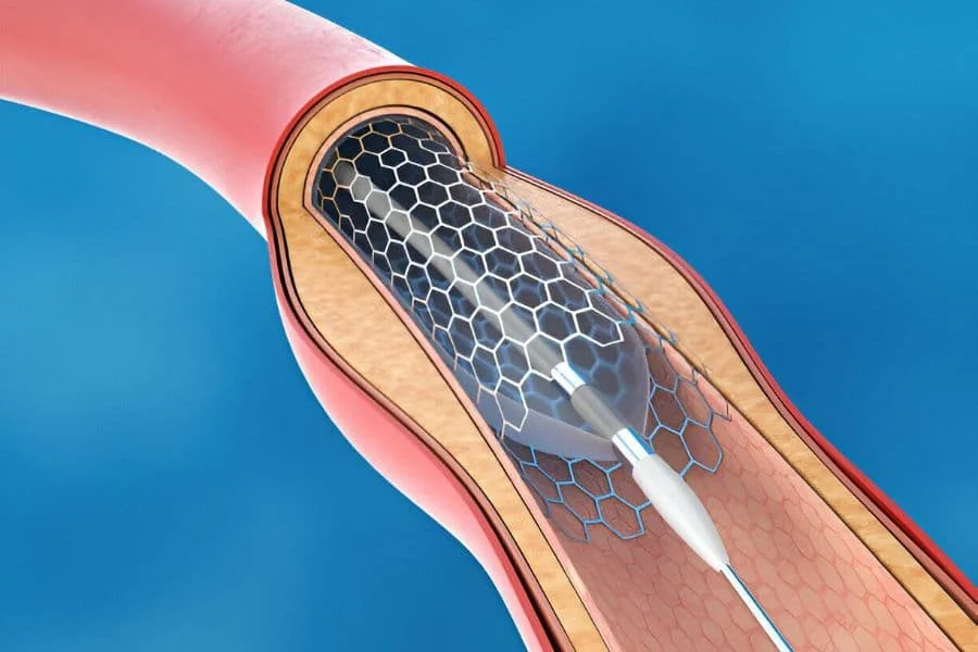 5.3 Medical Stent Implantation For Blood Circulation